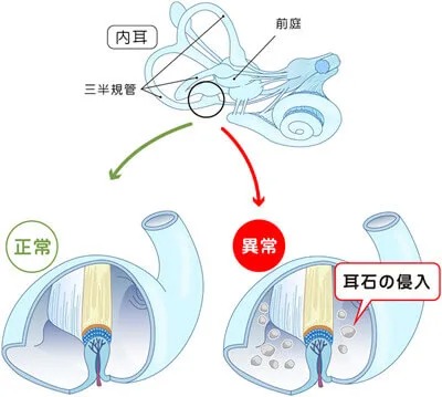 三半規管と耳石の様子