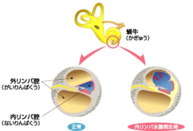 内リンパ水腫の構造図