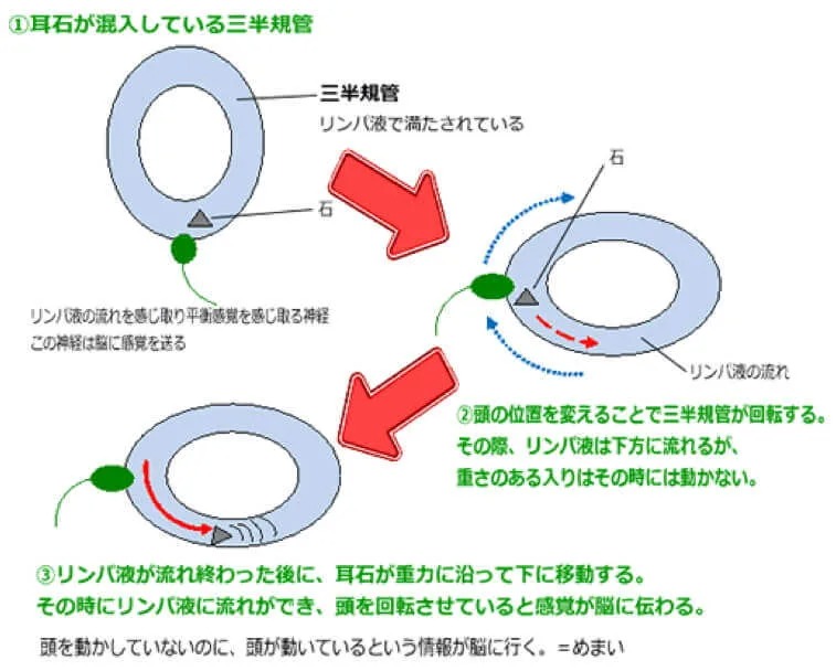 良性発作性頭位めまいのイラスト